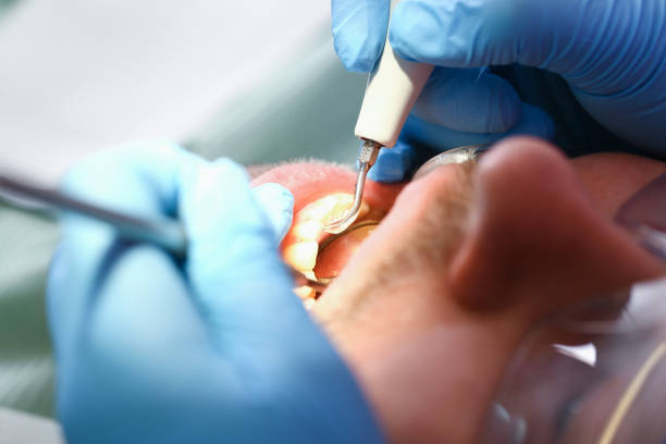 Best Emergency Tooth Extraction in Cabot, AR